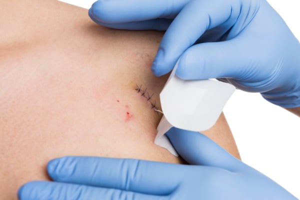 Vitalcare minor surgical procedures - stitches